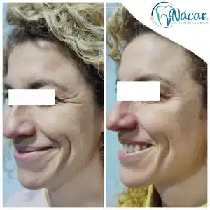 botox patas de gallo