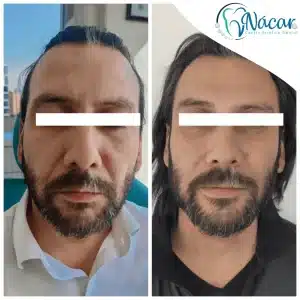 Hilos revitalizantes PDO