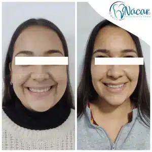 bichectomia