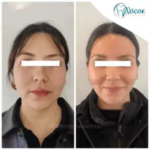 pomulos y lifting facial