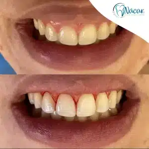 gingivectomia