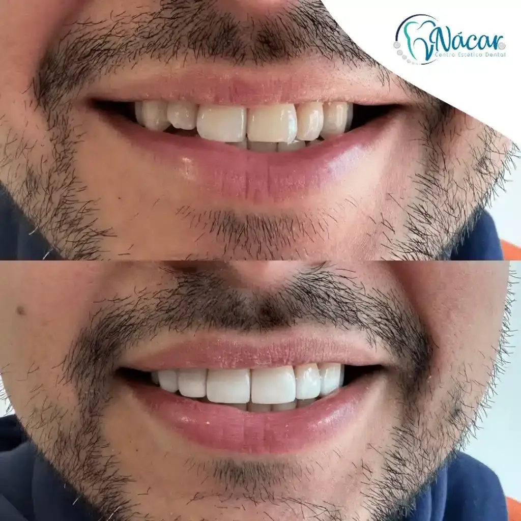 diseño de sonrisa