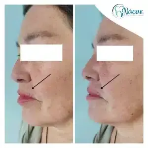 Tratamiento hilos revitalizantes PDO