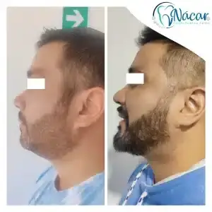 Mesoplastía de papada