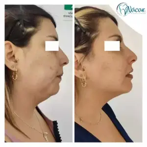 Rinomodelación y Mentón