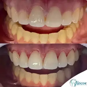 gingivectomía