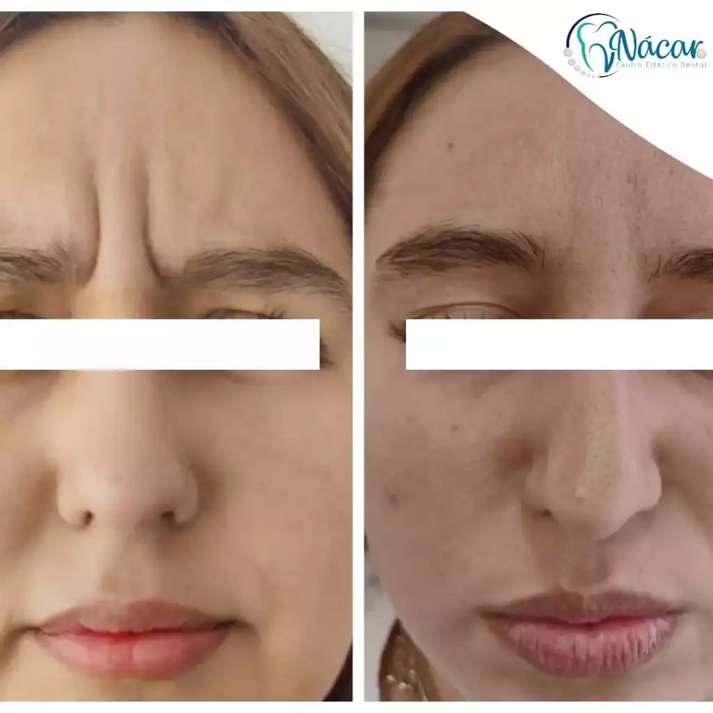 botox entrecejo