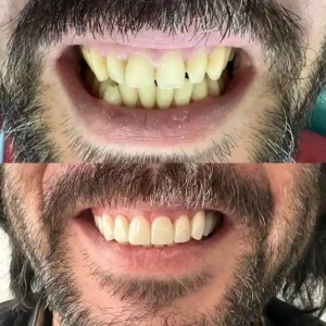 Diseño de Sonrisa con Carillas de Resina