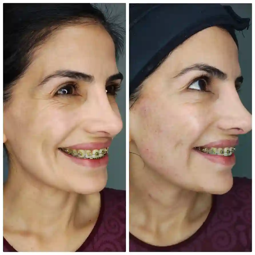 Sculptra