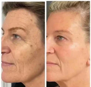 Radiofrecuencia Fraccionada tipo Morpheus8 + Exosomas