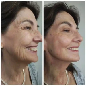 Sculptra