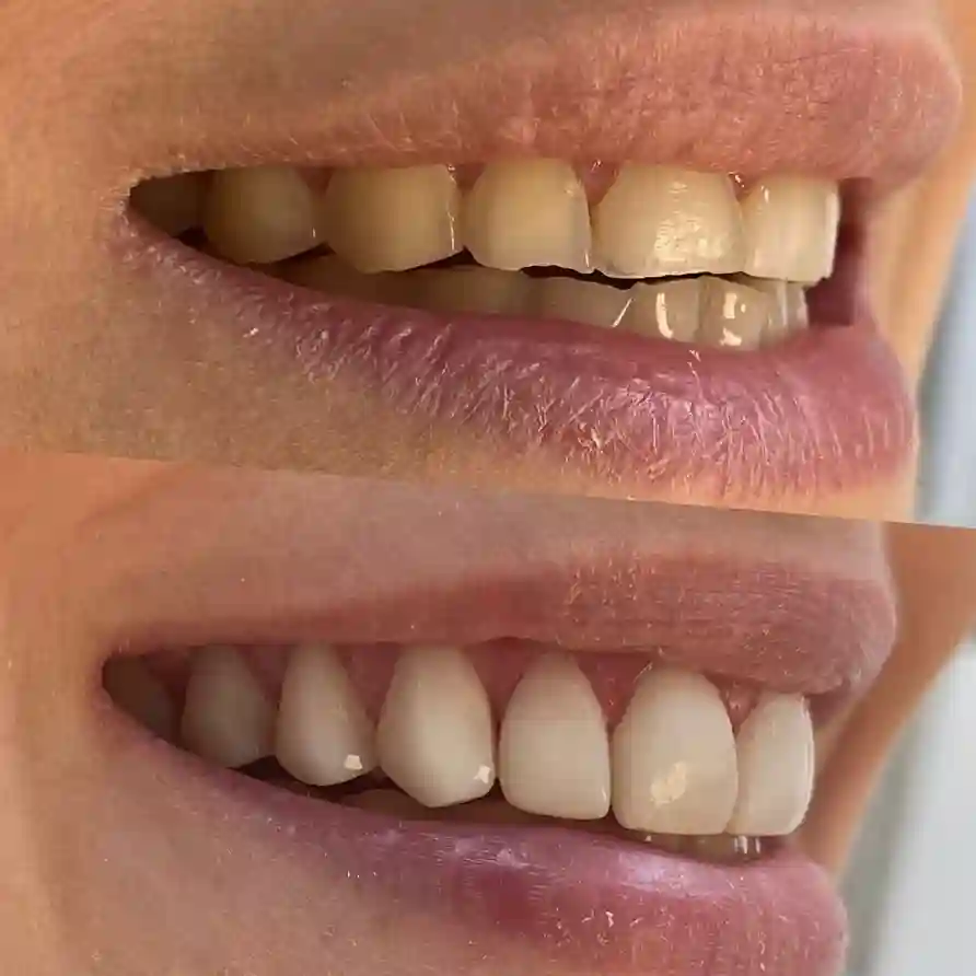 diseño de sonrisa