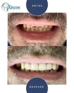 Diseño de Sonrisa con Carillas de Resina