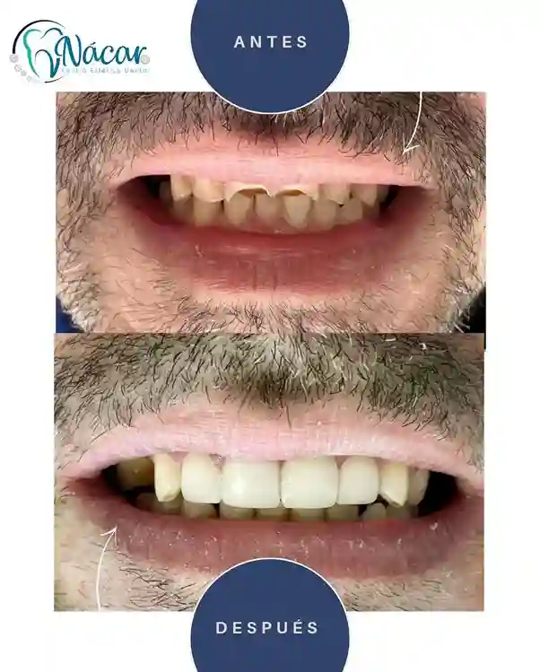 diseño de sonrisa