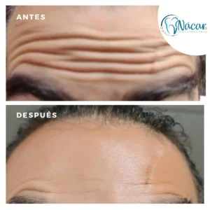 Botox Frente