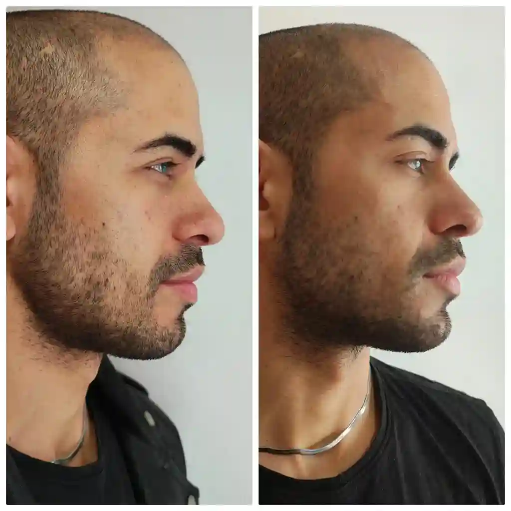 Mentón y Marcación Mandibular