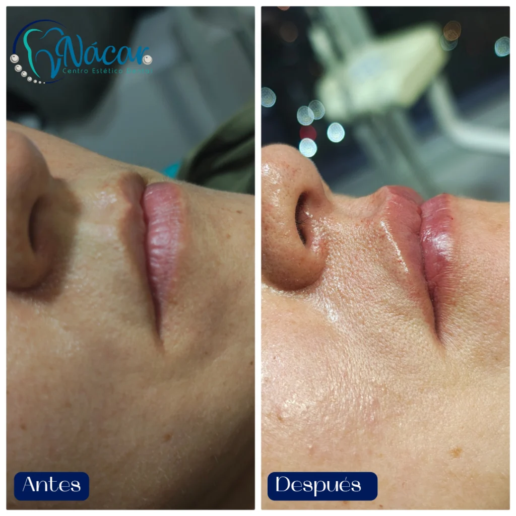 Perfilado y Aumento de Labios