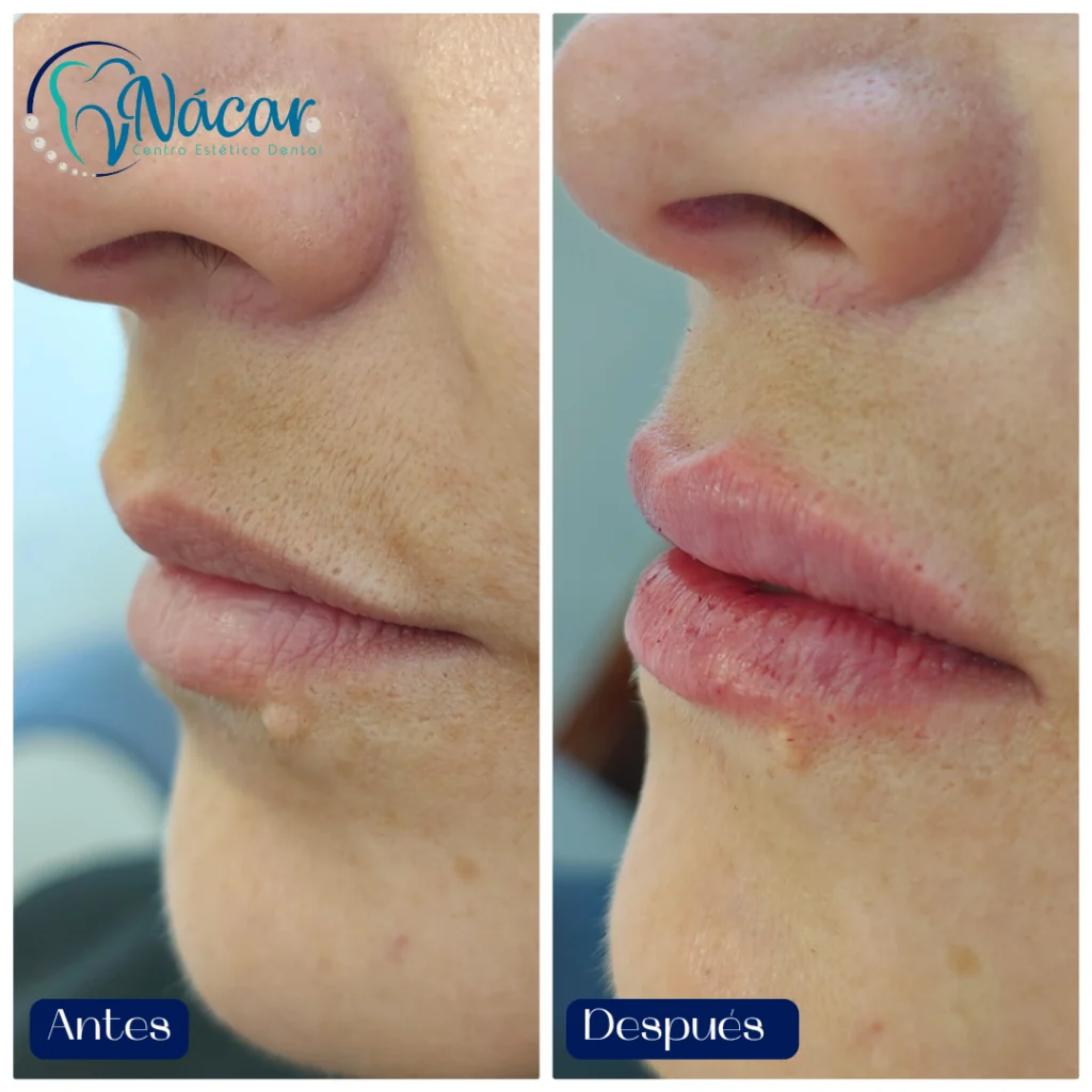 Perfilado y Aumento de Labios