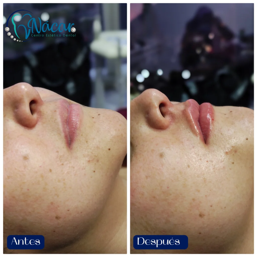 Perfilado y Aumento de Labios