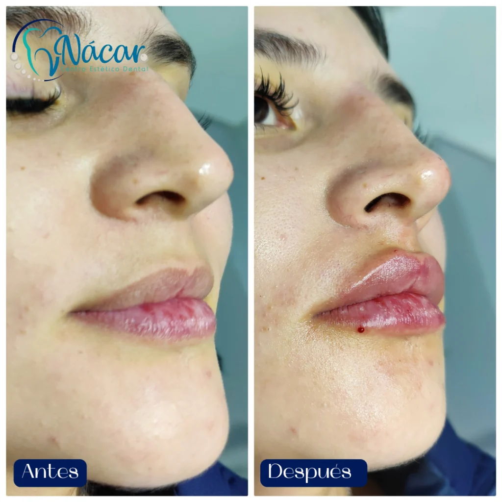 Perfilado y Aumento de Labios