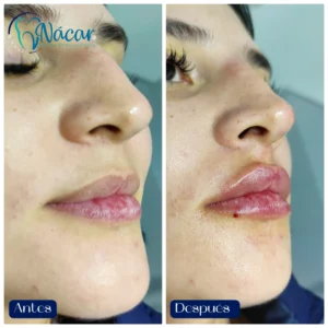 Perfilado y Aumento de Labios