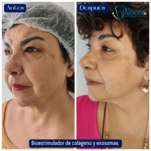 Radiofrecuencia Fraccionada + polinucleótidos