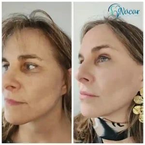 Regeneración con Morpheus8 y Polinucleótidos