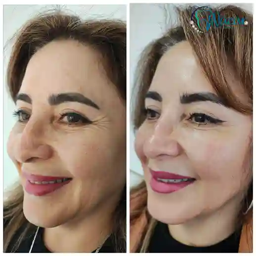 Regeneración con Morpheus8 y Polinucleótidos + Rinomodelación con ácido hialurónico