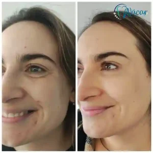 Regeneración con Morpheus8 y Polinucleótidos