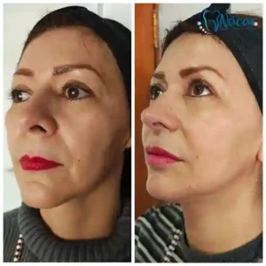 Regeneración con Morpheus8 y Polinucleótidos + Rinomodelación con ácido hialurónico