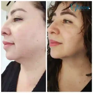 Mesoplastía de Papada y Morpheus8