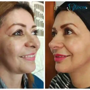 Regeneración con Morpheus8 y Polinucleótidos + Rinolips con ácido hialurónico