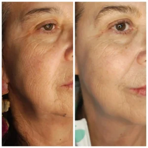 Radiofrecuencia Fraccionada + Polinucleótidos Adn de Salmón