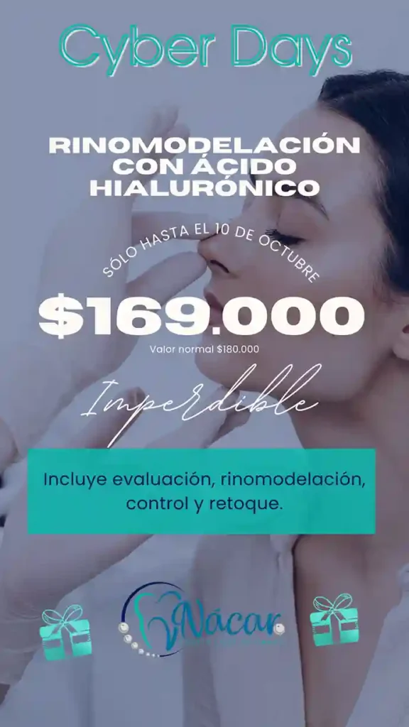 Rinomodelación con Ácido Hialurónico