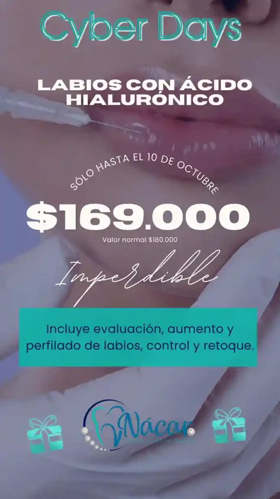 Labios con Ácido Hialurónico