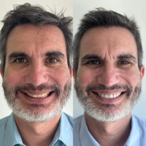 Diseño de Sonrisa con Carillas de Cerámica