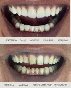 Diseño de Sonrisa con Carillas de Cerámica