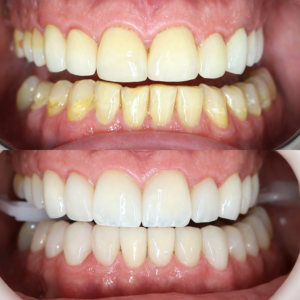 Diseño de Sonrisa con Carillas de Resina