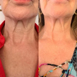 Radiofrecuencia Fraccionada en cuello y papada