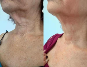 Radiofrecuencia Fraccionada en cuello y papada