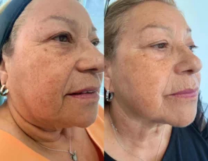 Radiofrecuencia Fraccionada