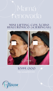 Promo Lifting Facial Mes de las Madres