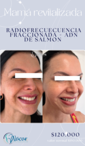 Promo Adn de Salmón + Radiofrecuencia Morpheus8 Mes de las Madres