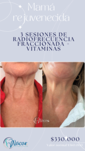 Promo Radiofrecuencia Morpheus8 Mes de las Madres